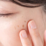 そのシミ、肝斑かもしれません